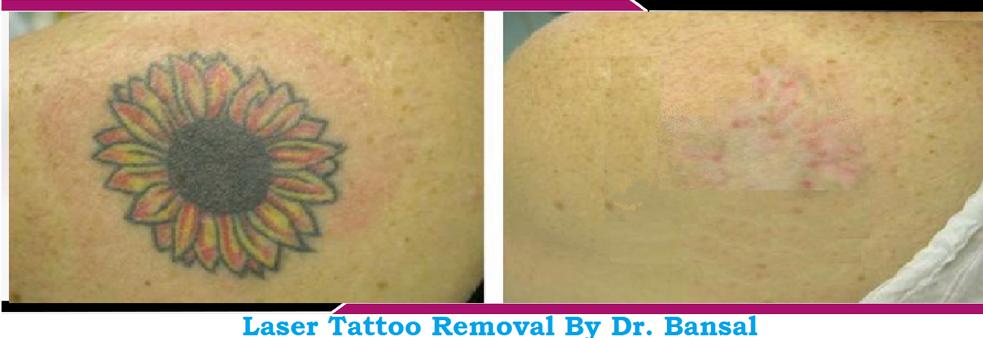 Laser Tattoo Removal treatment in chandigarh